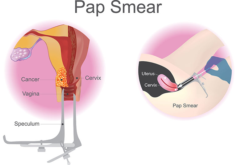 pap smear test